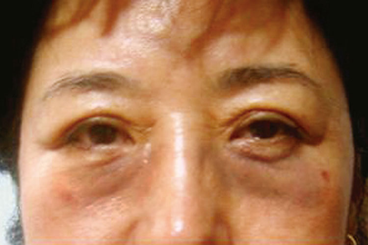 シワ（女性54歳）施術前
