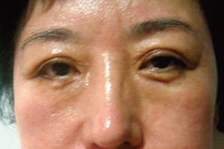 シワ（女性54歳）6回施術後